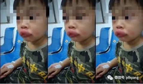 男孩吃葡萄過敏腫成嘟嘟嘴怎么回事？畫面詳情曝光網(wǎng)友忍不住笑了