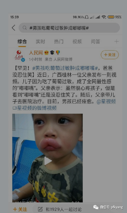 男孩吃葡萄過敏腫成嘟嘟嘴怎么回事？畫面詳情曝光網(wǎng)友忍不住笑了(圖3)